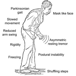 علائم و نشانه های بیماری پارکینسون