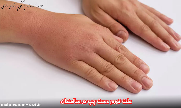 علت تورم دست چپ در سالمندان