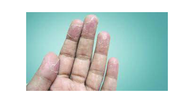 علت پوسته شدن انگشتان دست